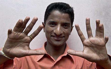 Record du monde : 12 doigts et 14 orteils !