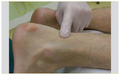 Le traitement des ruptures du tendon d’Achille