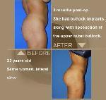 buttock-aug-implant-lrg-3