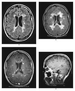 Scans cérébraux d'un patient atteint de sclérose en plaque
