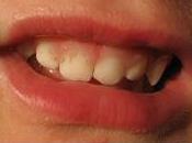 traitements précoces orthodontie