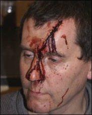 Un membre du BNP agressé à coup de marteau par des nervis d'extrême gauche