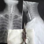 Il avale une paire de ciseaux qu'il utilisait comme cure-dent