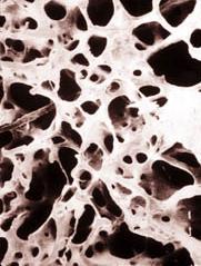 La perte des dents associées à l'ostéoporose