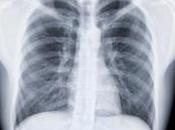 Tuberculose découverte encourageante pour améliorer traitements