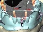 Chirurgie implantaire flapless, guidée ordinateur, mise charge immédiate