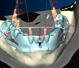 Chirurgie implantaire flapless, guidée par ordinateur, mise en charge immédiate