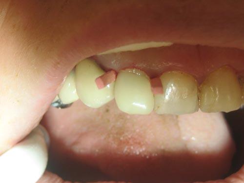 Dentisterie restauratrice extrême: technique moulodus+tenon en fibre de carbone