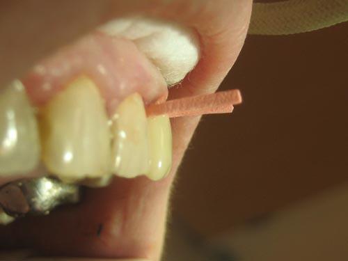 Dentisterie restauratrice extrême: technique moulodus+tenon en fibre de carbone