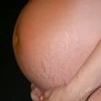 soin des vergeture pendant la grossesse