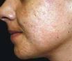 comment soigner les cicatrices d'acné