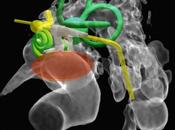 Traitements Acouphènes Stimulation Electrique Implants ExtraCochléaires (2ème partie)