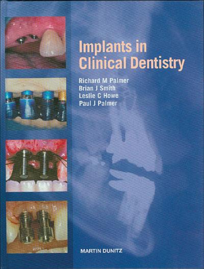 Palmer's Implants in Clinical Dentistry! One of the best books on Implants!