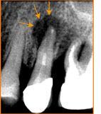 Polyarthrite rhumatoïde et abcès dentaire