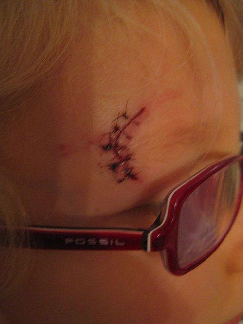 Encore un peu de couture aux urgences !