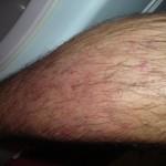 eczema jambe karite