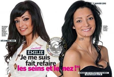 Emilie (Secret Story 3) s'est faite refaire les seins