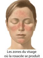 La rosacee ne rougissez pluss, souriez plutot...