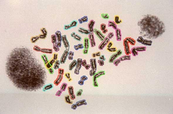 Les chromosomes chez un foetus. 