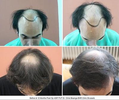 4297 + 660 FUT - BHR Clinic - Dr. Bisanga - Clinique greffe de cheveux - photos avant après