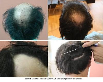 4297 + 660 FUT - BHR Clinic - Dr. Bisanga - Clinique greffe de cheveux - photos avant après