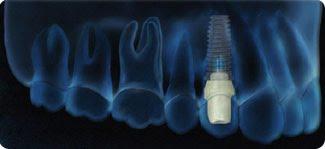 Formation 3i, débuter en prothèse sur implant.