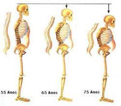 L'ostéoporose: un mal souvent ignoré