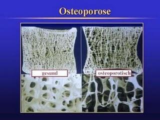 L'ostéoporose: un mal souvent ignoré