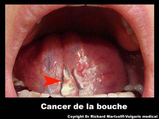 http://www.vulgaris-medical.com/upload/visuel-cancer-bouche-7ea.jpg