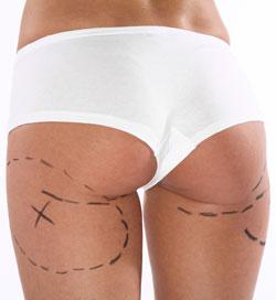 Tendance, les implants fessiers