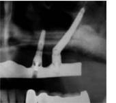 Implants zygomatiques et autres implants dentaires maxillo-faciaux