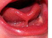 Frein de la langue : mobiliser après freinectomie