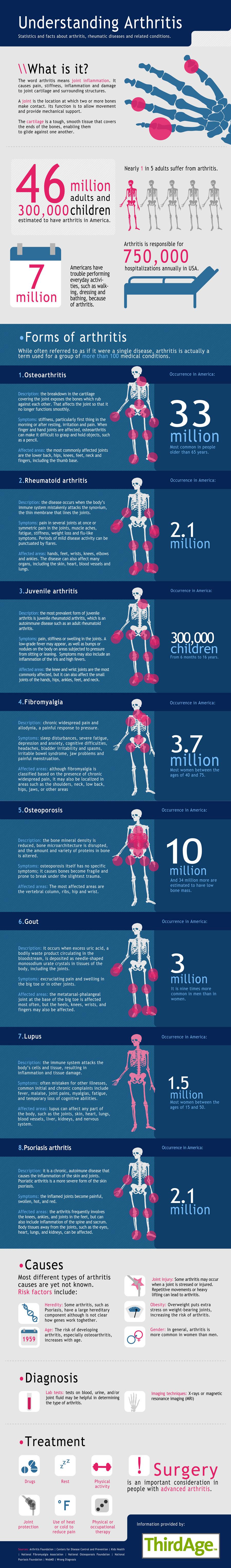 Une infographie pour comprendre les différentes formes d’arthrite