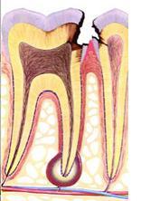 dent dévitalisée : régénérer la pulpe ou nerf dentaire pour préserver sa vitalité