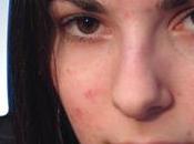 Traitement l'acné hormonale chez femmes