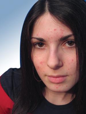 comment conseils traiter prévenir l'acné hormonale pour femme jeunes fille