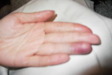 Les séquelles de l'agression de la jeune-fille. Photo (c) Amaury van Hoorebeke