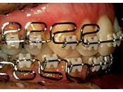 Orthodontie bien choisir anti-douleur analgésique