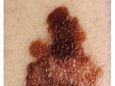 Cancer peau comment reconnaître mélanome malin