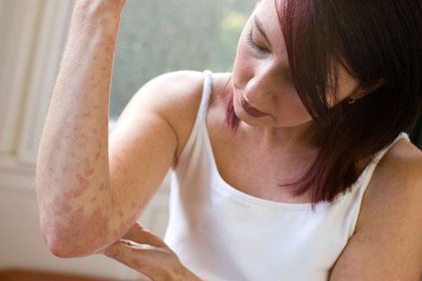 quelles sont les causes et symptomes de l'eczema