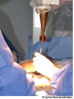 Une séance unique de radiothérapie et non plus… une trentaine comme c’est actuellement le cas !