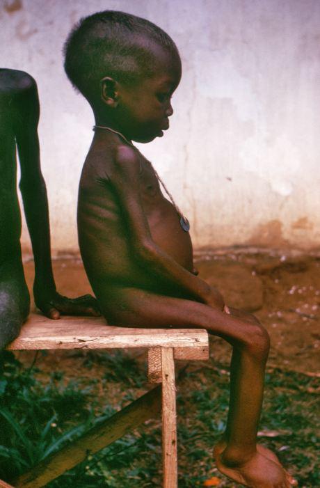 L'IMAGE DU JOUR: Jeune fille atteinte de kwashiorkor