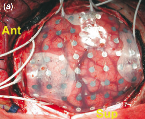 Les Mesures Objectives - l'Electro-encéphalographie (EEG) EEG.png