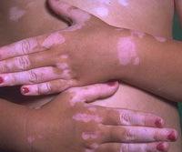 vitiligo3_resize.jpg