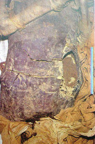 Momification - Incision abdominale Ramsès II