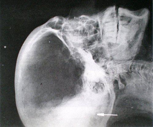 Momification - Bouclier occipital crâne Séthi Ier (Bucail