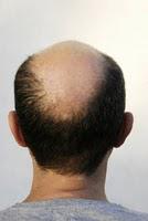 La caféine pour lutter contre la calvitie