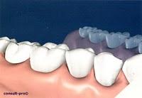 Qu'a une dent contre qui ?