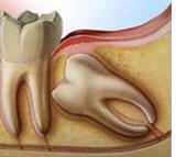 Auto-transplantation d'une dent de sagesse : alternative naturelle à la pose d'implant