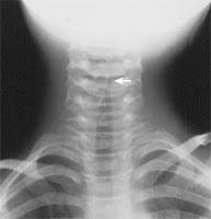 Un autre forme de grippe